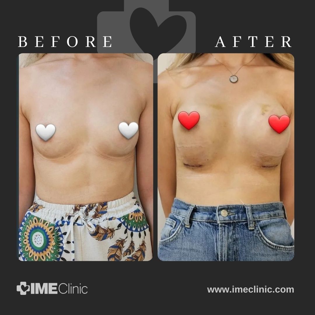 Before and after comparison of a persons torso post breast lifting surgery. Both images show a woman in shirts with hearts over her chest area, highlighting the changes. The background features a transparent heart symbol. Text reads IMEClinic and www.imeclinic.com.
